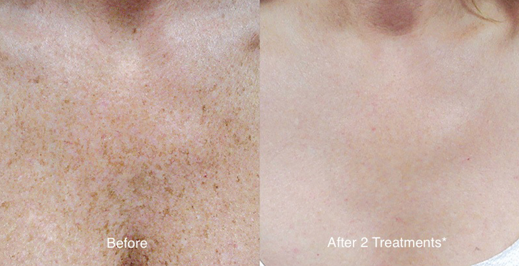 Pigmentation-1