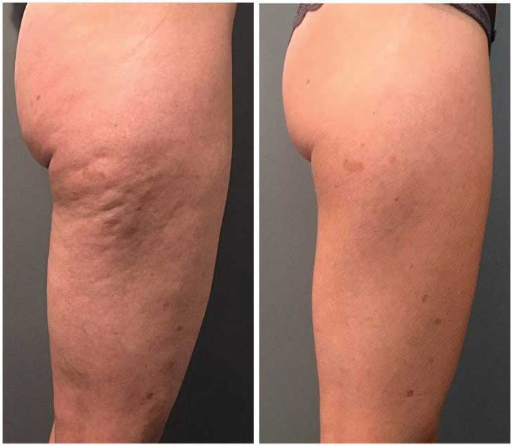 profound-body-before-and-after