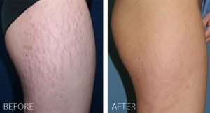 stretch-marks-2-300x162
