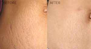stretch-marks1-300x162